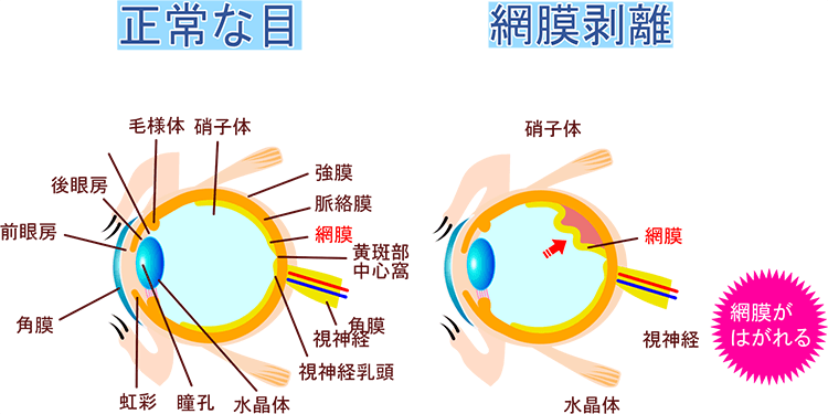 正常な目と網膜剥離の比較イラスト